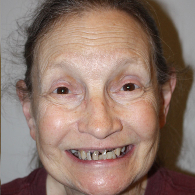 full-smile-07-before