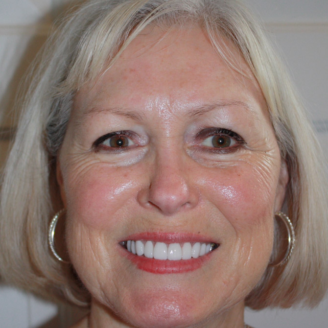 full-smile-12-after