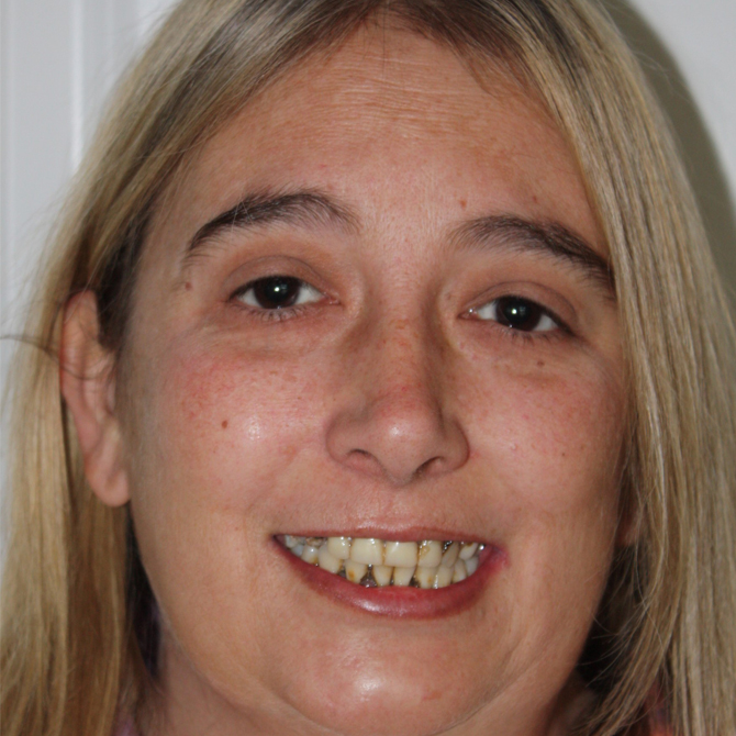 Smile-Wilks-Before